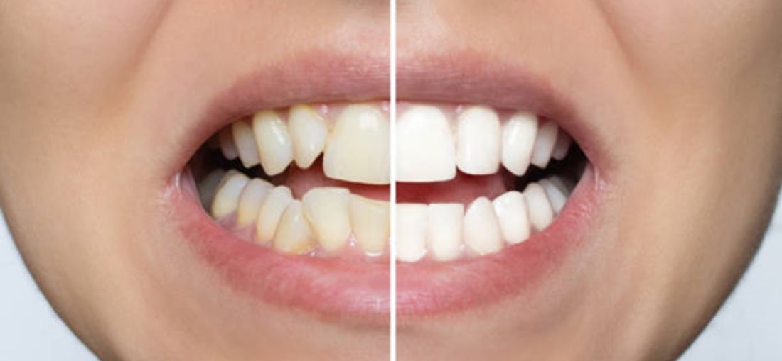 Especialista explica como a posição dos dentes pode influenciar desde a mastigação até a saúde em geral